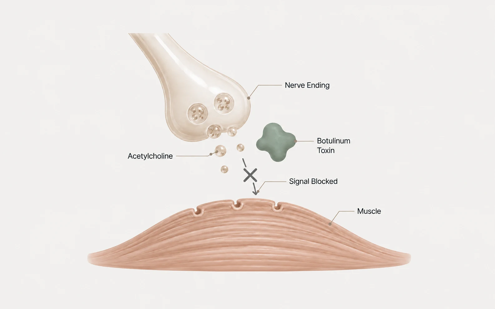 Labeled cross-section: a nerve ending releases acetylcholine toward a muscle, and a botulinum toxin molecule blocks the signal before it arrives