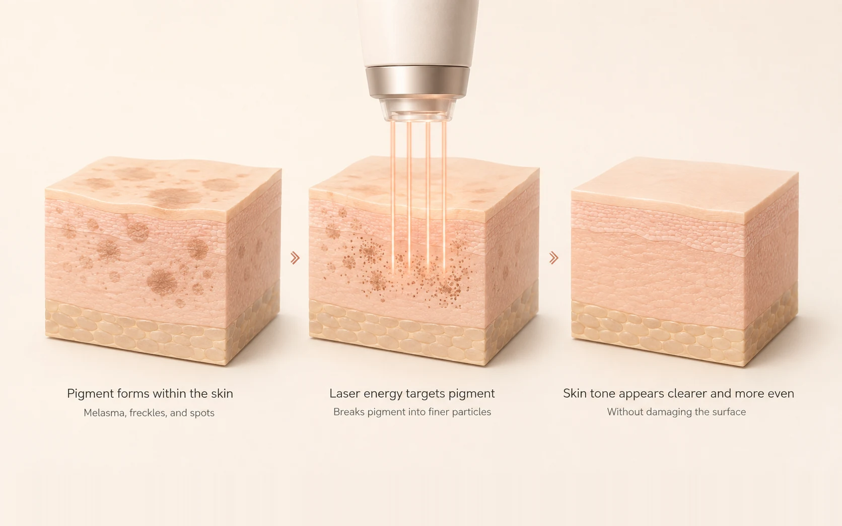 Three labeled skin cross-sections: pigment formed within the skin, a laser handpiece breaking that pigment into finer particles, and the resulting clearer, more even tone