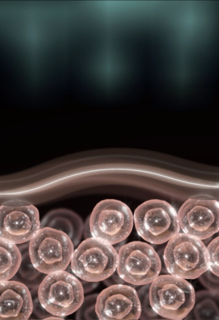 Thermage FLX radiofrequency heating the deep dermis — illustration 1 of 2
