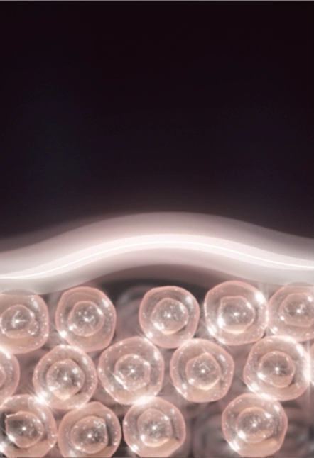 Thermage FLX radiofrequency heating the deep dermis — illustration 2 of 2